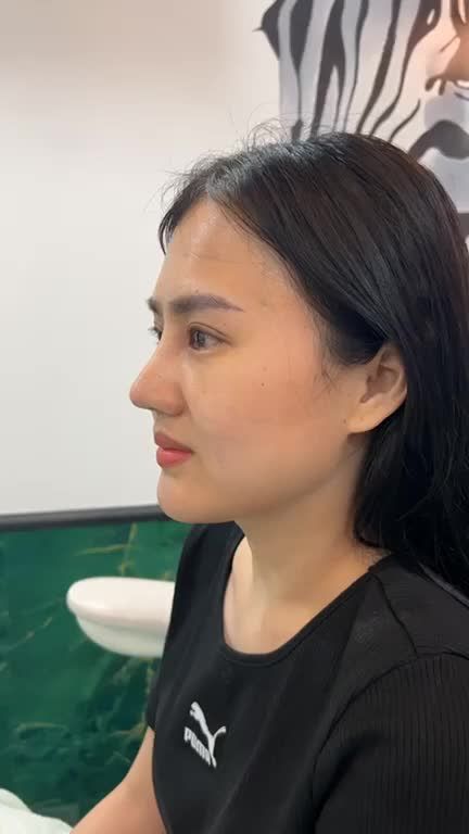 Mũi bọc sụn tháo nẹp, tái khám sau 10