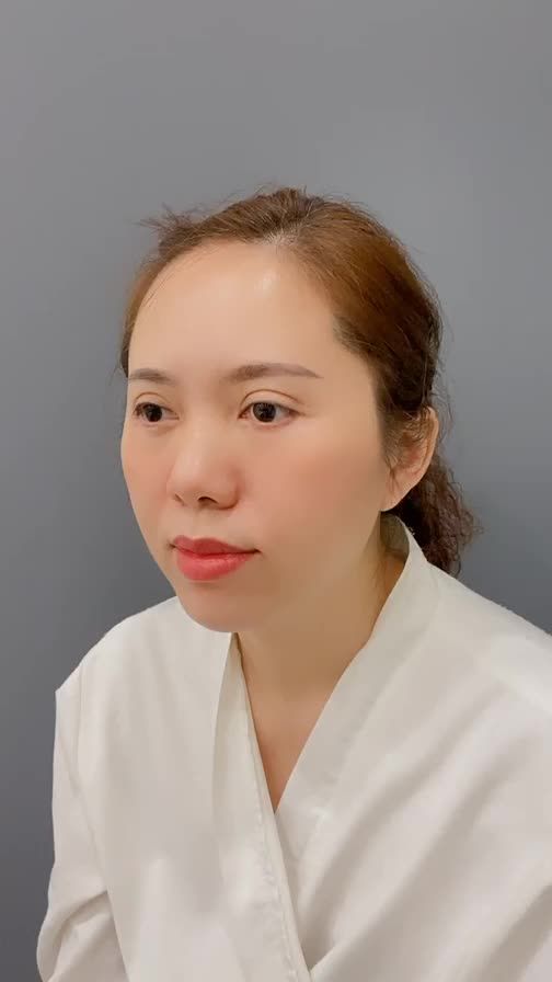 CA MŨI SIÊU CẤU TRÚC SURGIFORM
