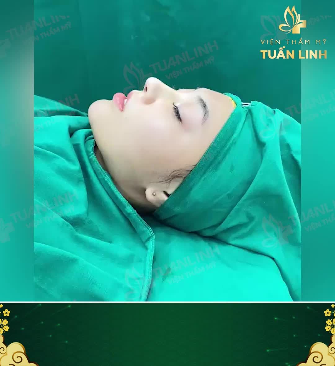 Nâng mũi cấu trúc chỉ với 19TR900 - Sở hữu ngay dáng mũi đẹp hết ''nấc'' - Giá sale sốc chưa từng có trước giờ.