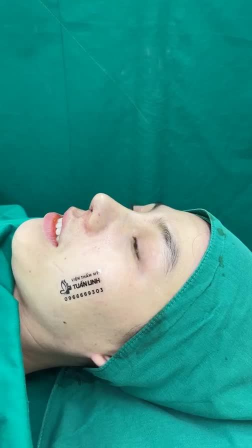 Mũi cấu trúc surgiform vừa hoàn thành