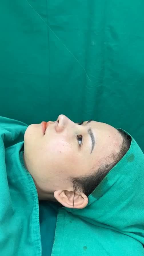 Case mũi cấu trúc surgiform vừa hoàn thành