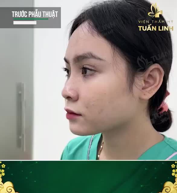 CHỈ 7-10 NGÀY MŨI VÀO PHOM ĐẸP TỰ NHIÊN.