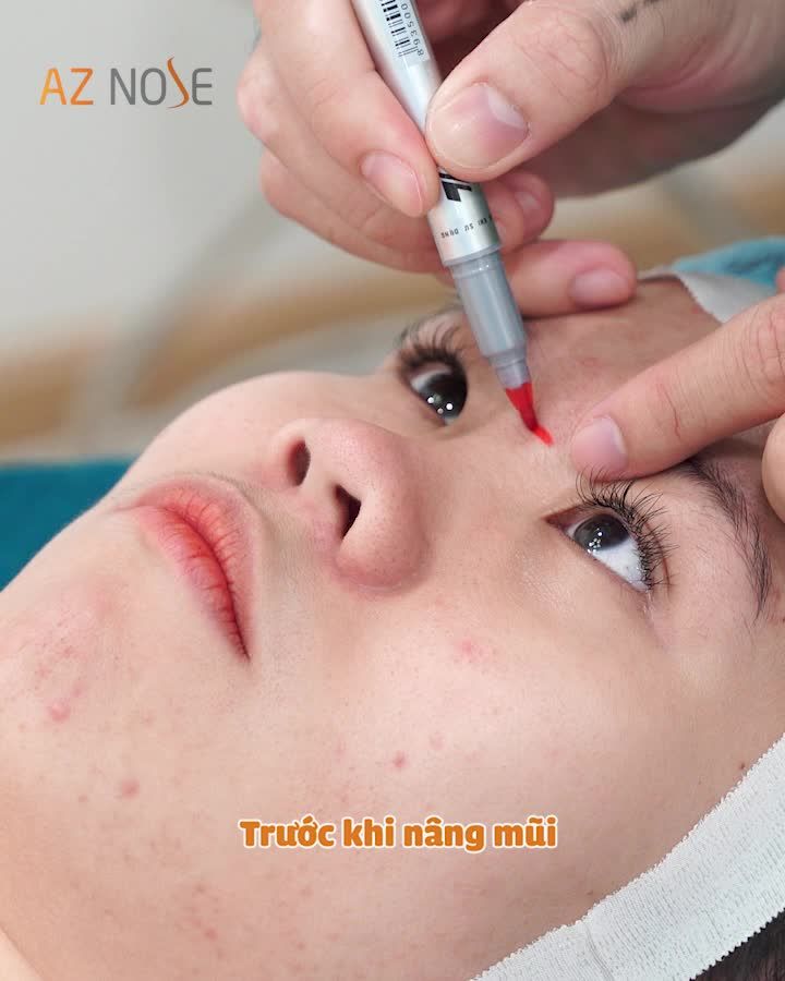 Không hài lòng với chiếc mũi th.ấp b.è, nàng 2K quyết tâm làm đẹp trước thềm năm mới