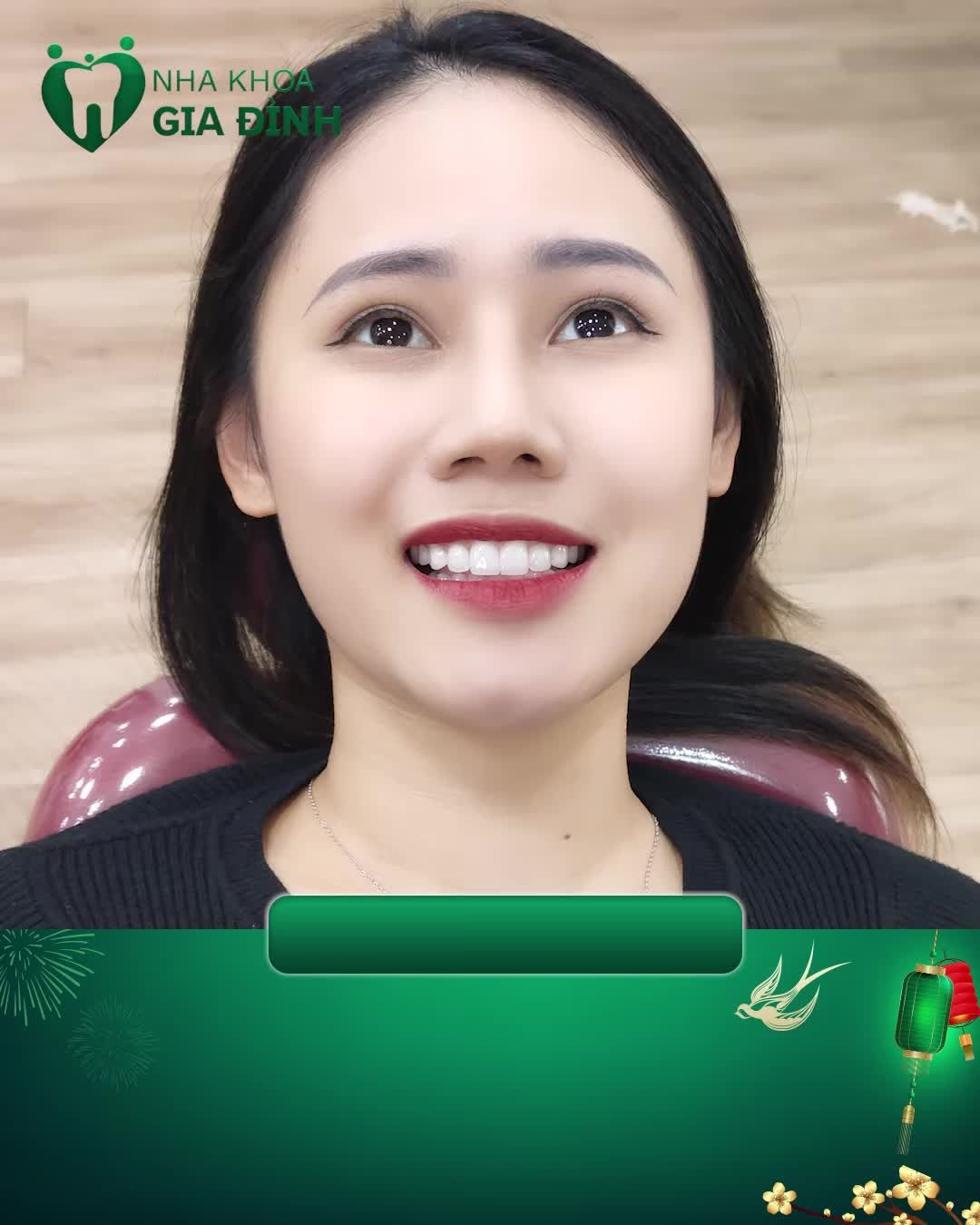 TẨY TRĂNG RĂNG - CƯỜI XINH ĐÓN TẾT