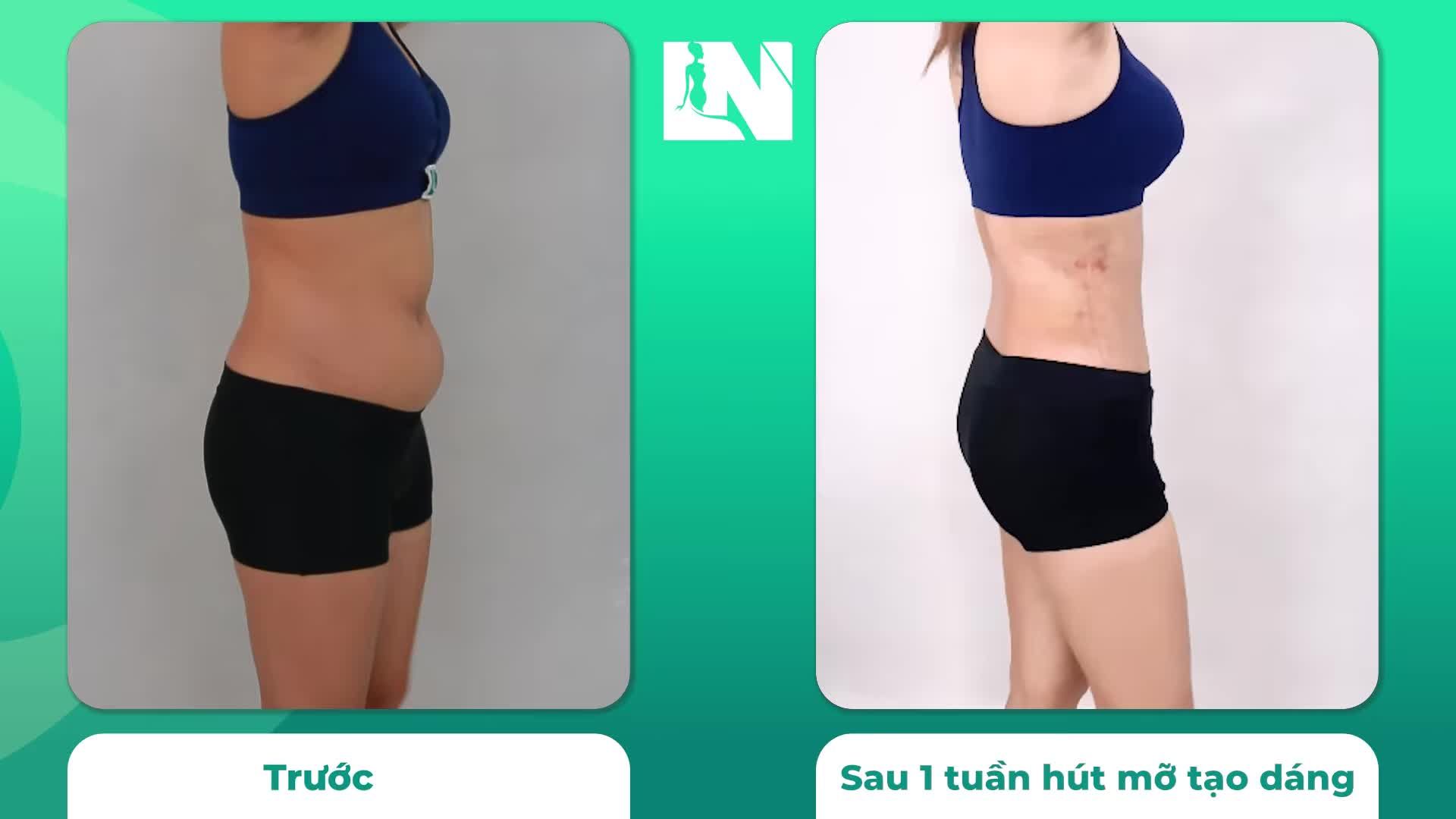 Thực hiện hút mỡ tạo dáng thẩm mỹ để chạm tay vòng eo thắt đáy - với Chị H.N (28 tuổi), mục đích không đơn thuần như thế: