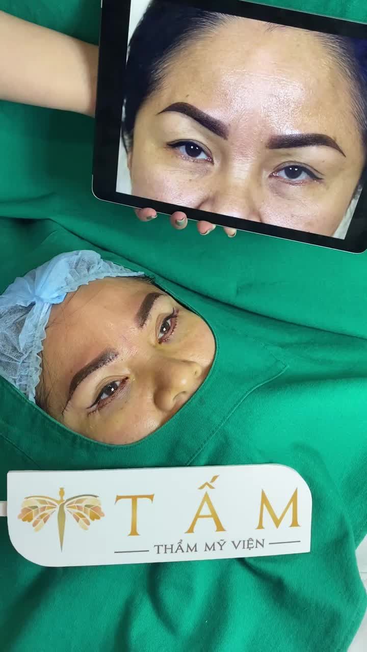 Chị khách nâng cung mày + cắt mí dưới tại Tấm. Chỉ sau 60 phút thực hiện dịch vụ, đôi mắt tươi trẻ rạng rỡ hơn.