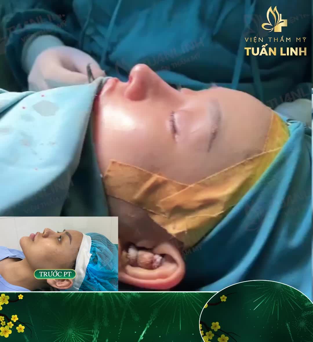 Đón năm mới nhiều may mắn, tài lộc cùng chiếc mũi cao xinh, hợp phong thủy.