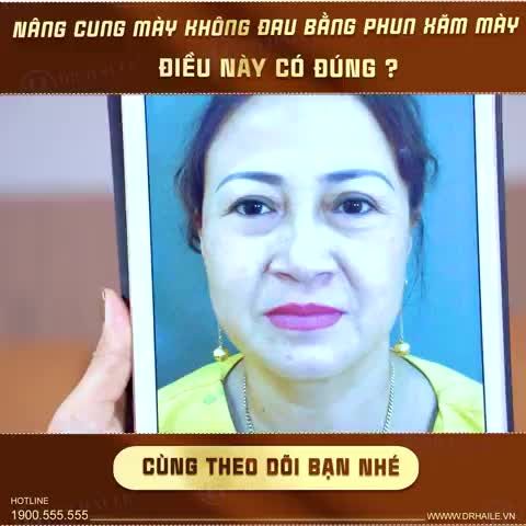 Mắt 2 mí không còn là mơ ước khi vị khách hàng đến với Dr.Hải Lê
