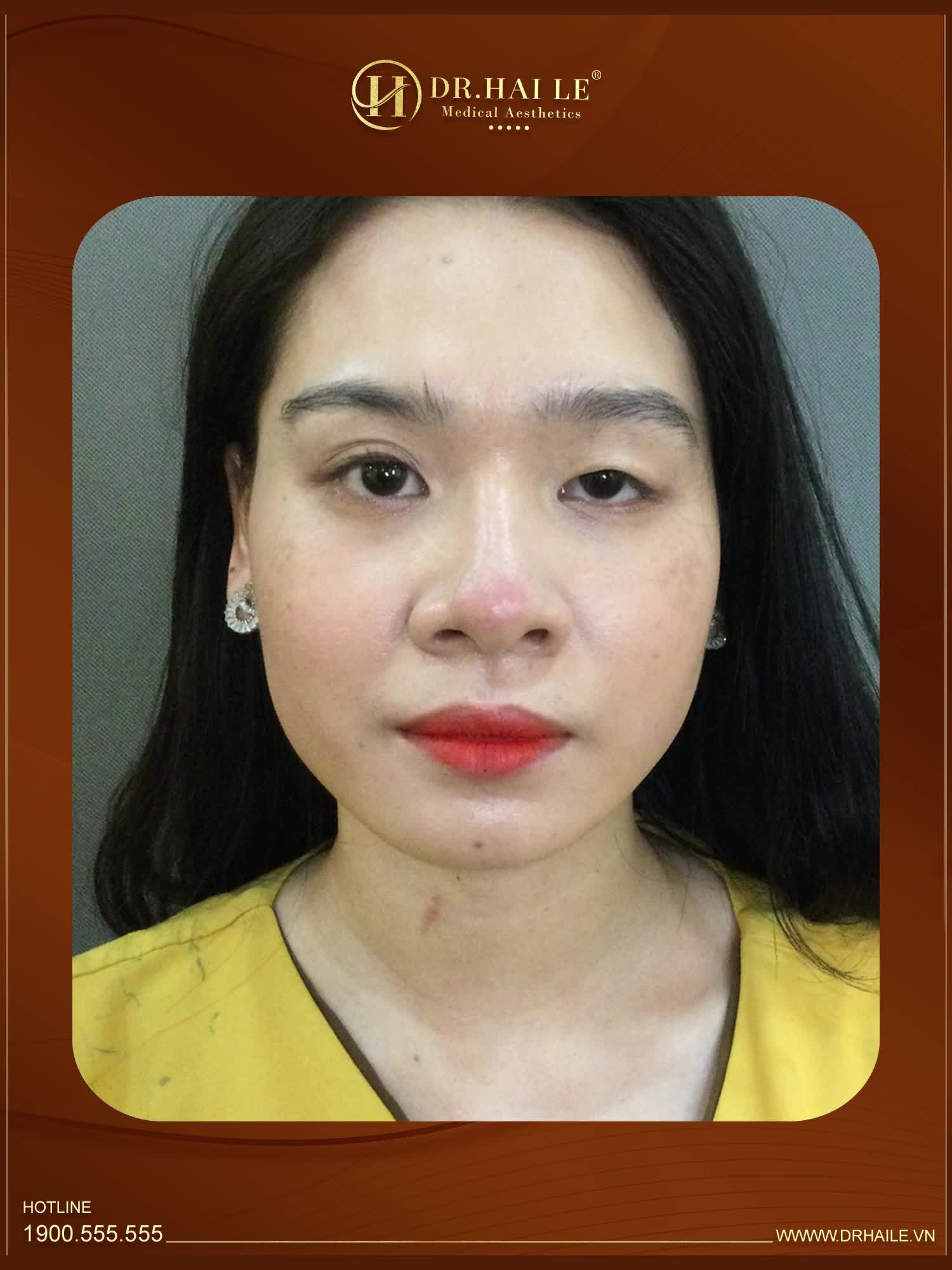 SỬA MÍ KHÓ - ĐÃ CÓ DR.HẢI LÊ