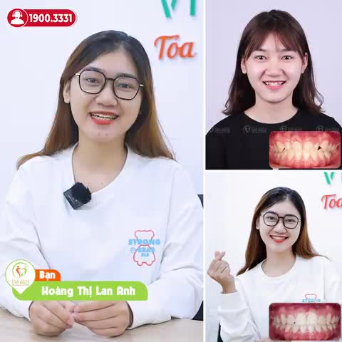 NIỀNG RĂNG CÓ BỊ SỤT CÂN, HÓP MÁ KHÔNG?