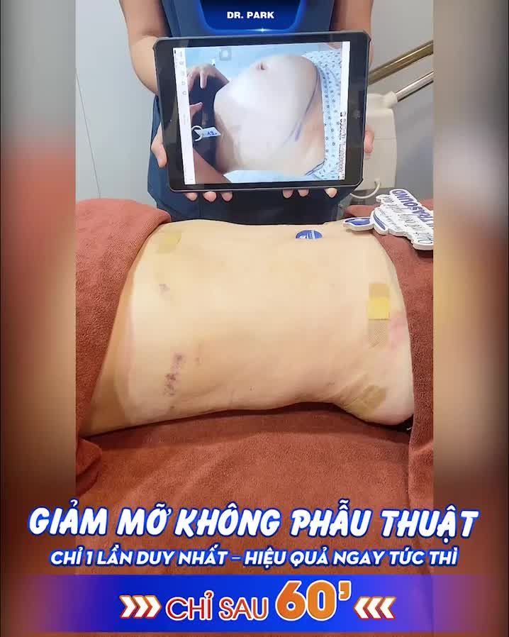 LIPO ULTRASOUND - CẬN TẾT VẪN XÓA MỠ KỊP