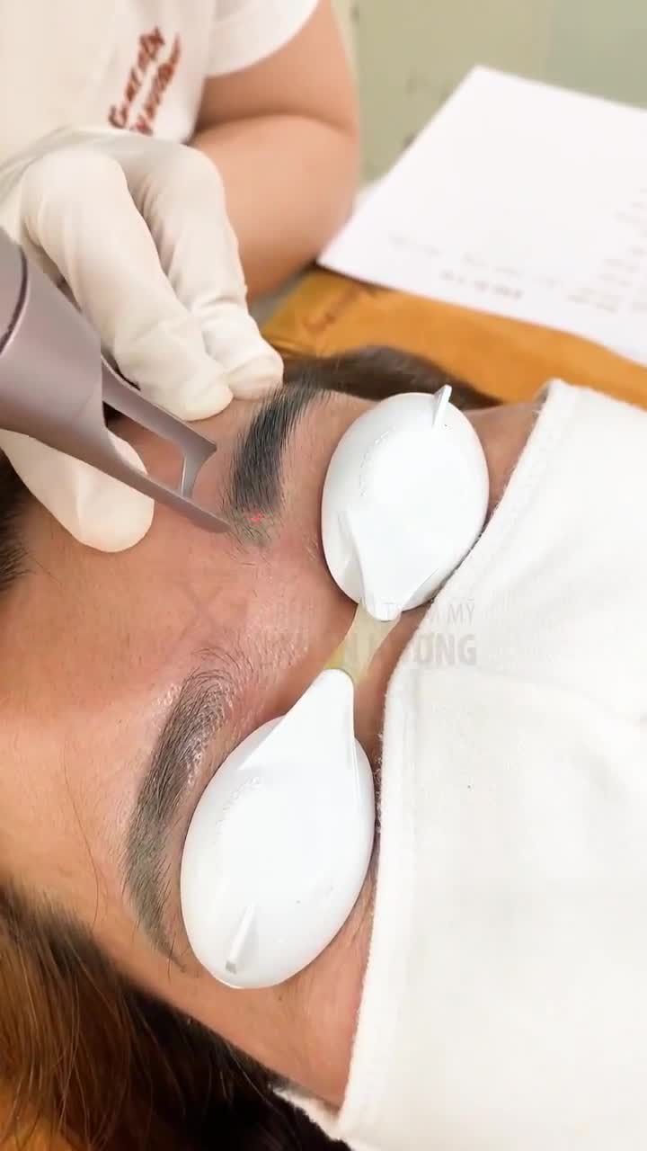 MỰC XĂM MÀY TRỔ XANH ĐƯỢC LOẠI BỎ NHANH CHÓNG CÙNG CÔNG NGHỆ LASER HIỆN ĐẠI