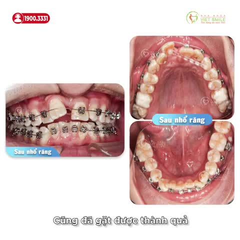 THÁO NIỀNG RĂNG KẸ THỪA, CHEN CHÚC SAU 2 NĂM