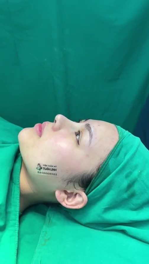 Ca nâng mũi cấu trúc vừa  hoàn thành