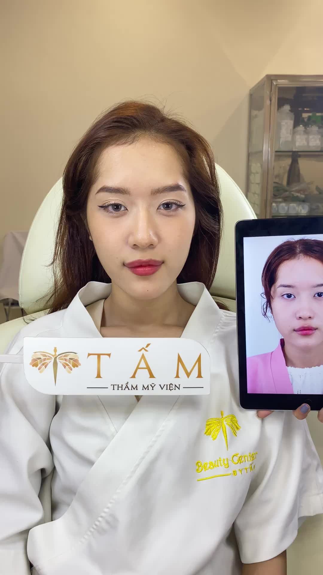 Ca Vline Perfect quay lại tái khám tại Thẩm mỹ viện Tấm.