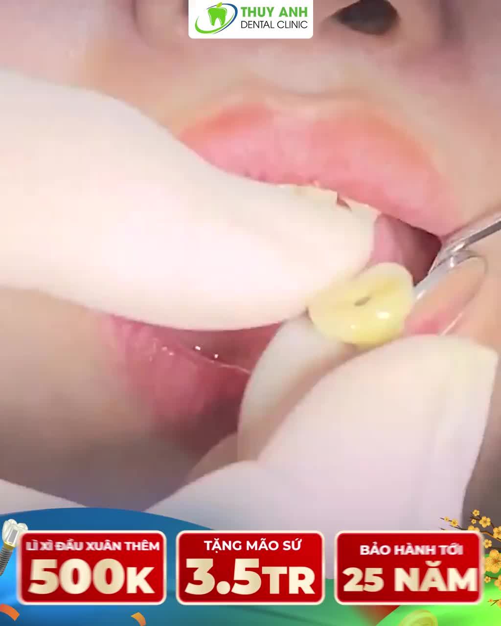 ĐẦU XUÂN TRỒNG RĂNG  ĂN NGON NHAI KHỎE - SỨC KHỎE ĐONG ĐẦY