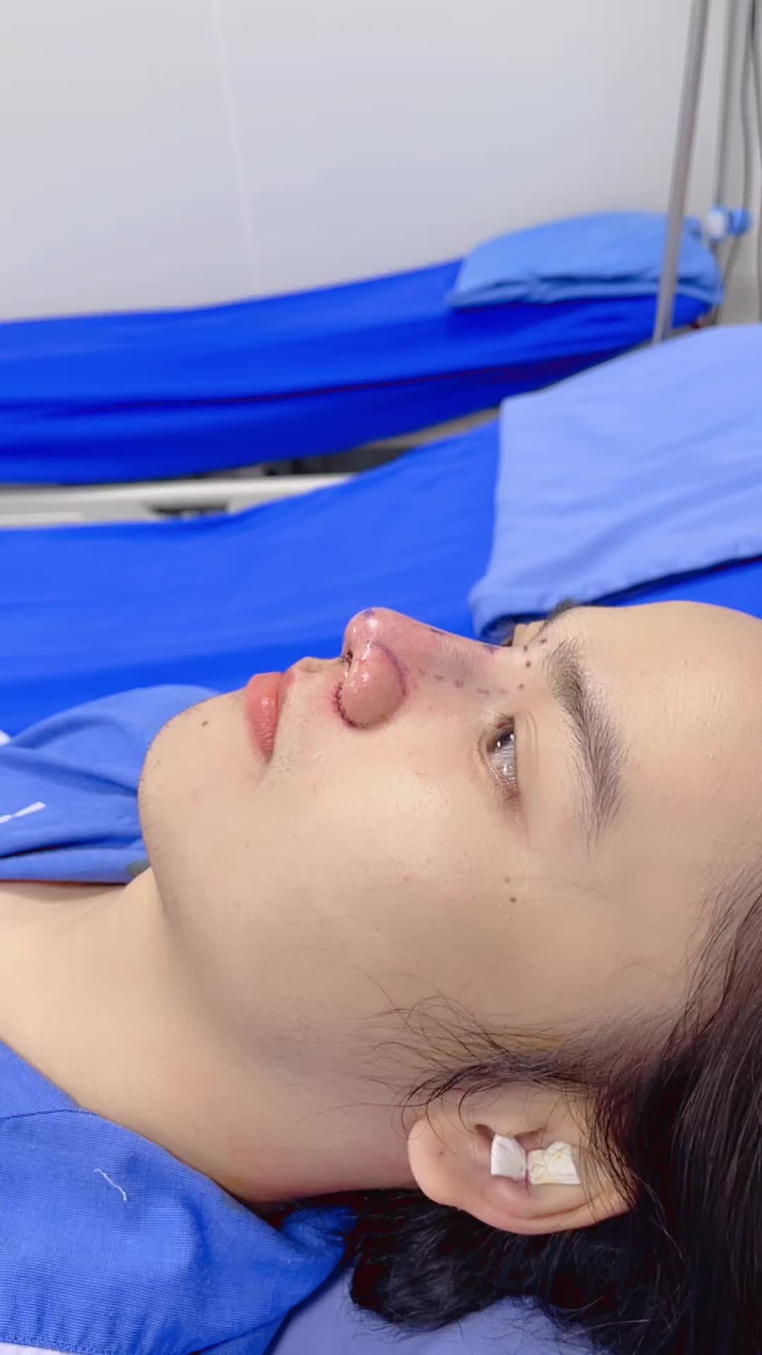 Kết quả khách hàng sau khi Nâng mũi tại Kangnam