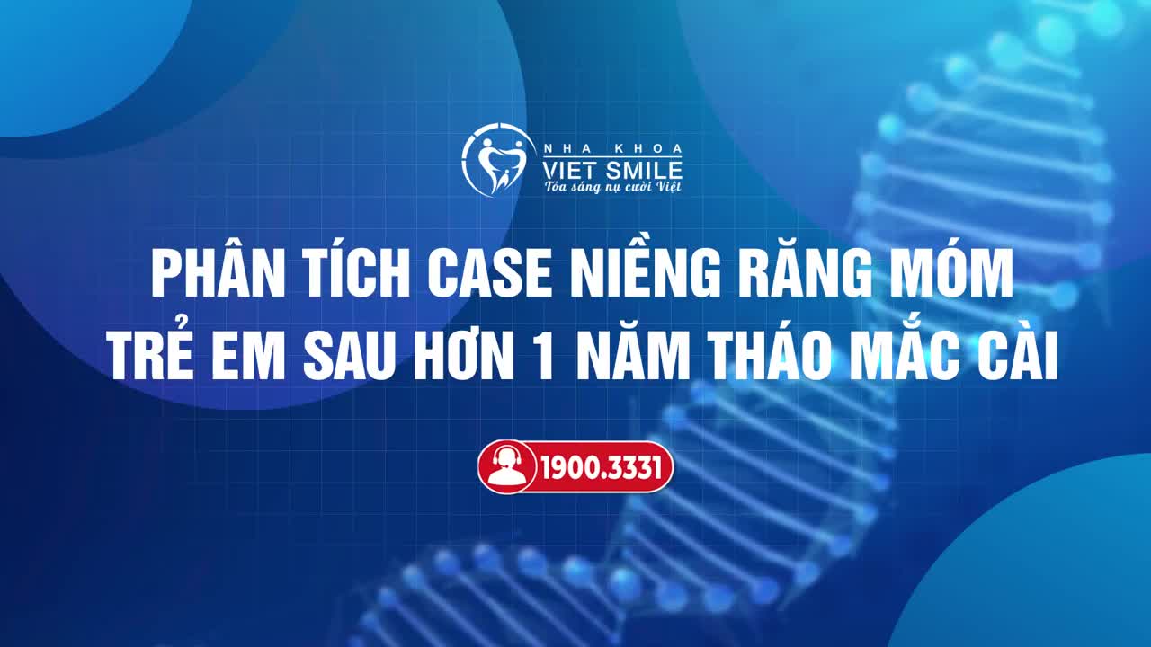 PHÂN TÍCH KẾT QUẢ NIỀNG RĂNG MÓM TRẺ EM SAU 1 NĂM