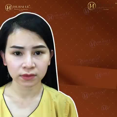 Cứ ngủ dậy là nếp mí biến mất, làm thế nào để mắt 2 mí luôn ở bên ta?