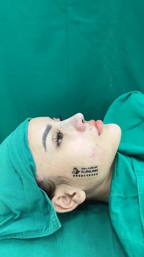 Case mũi cấu trúc sửa lại vừa hoàn thành
