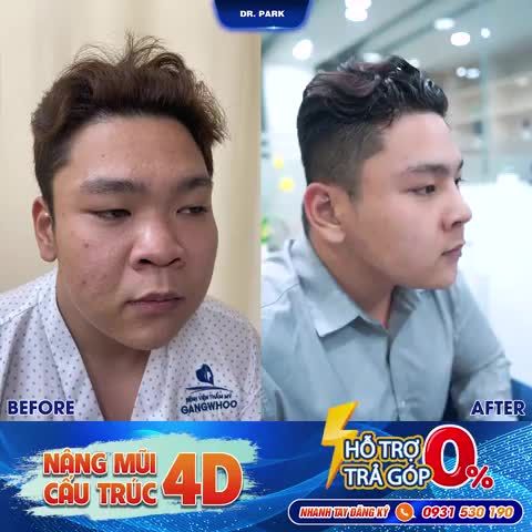 NAM GIỚI NÂNG MŨI - NAM THẦN NGOÀI ĐỜI THỰC CHỈ SAU 90 PHÚT