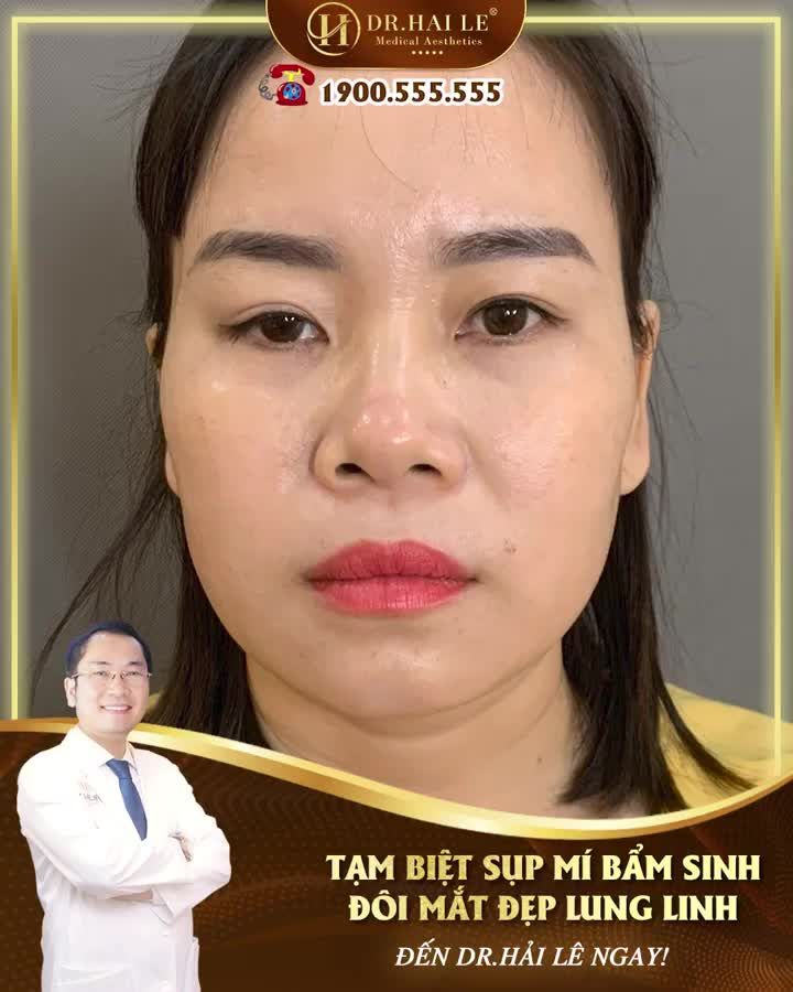 Mí sụp bẩm sinh là điều khiến bạn luôn phải suy nghĩ, phiền lòng mỗi ngày?