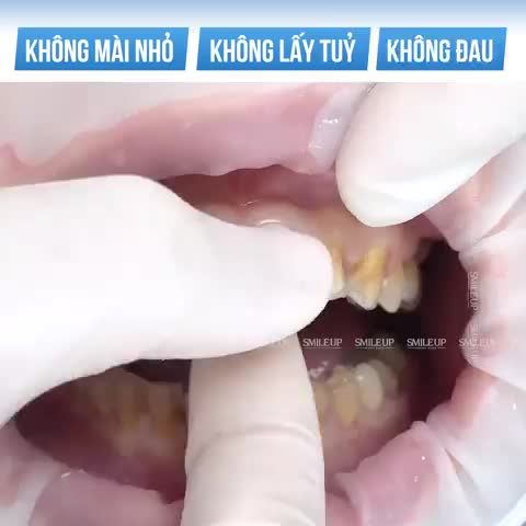 Tại sao các bác sĩ và chuyên gia khuyên bạn nên lựa chọn phương pháp thẩm mỹ răng sứ Veneer 