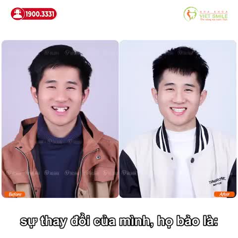 ĐẸP TRAI, TỰ TIN HƠN SAU THÁO NIỀNG RĂNG MÓM