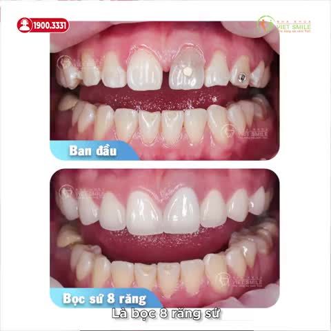 BỌC 18 RĂNG SỨ ĐÓNG KHE THƯA, KHẮC PHỤC RĂNG XỈN MÀU