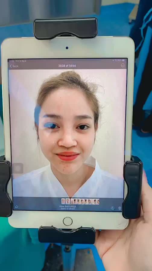 BẠN KHÁCH HÀNG CỰC XINH VỚI DÁNG MŨI PHONG THUỶ VỪA HOÀN THÀNH TẠI PHÒNG PHẪU THUẬT