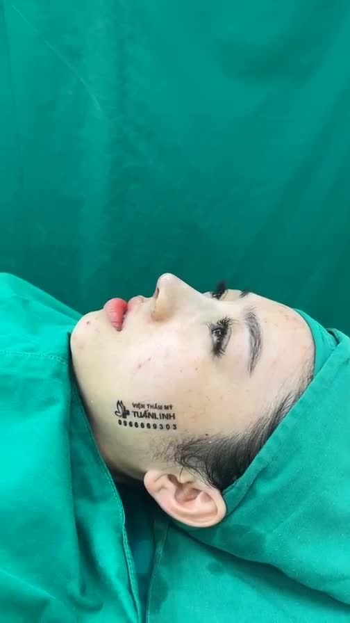 Case mũi cấu trúc vừa hoàn thành