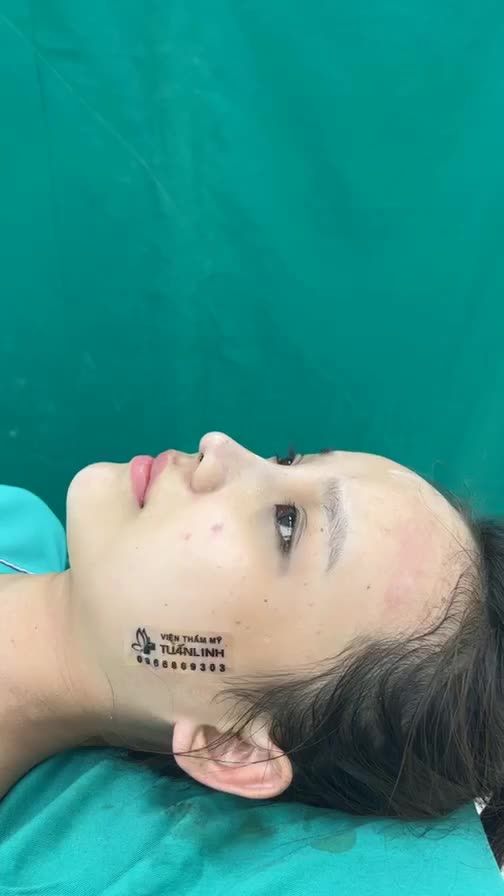 Case mũi bọc sụn cho bạn gái thích tự nhiên