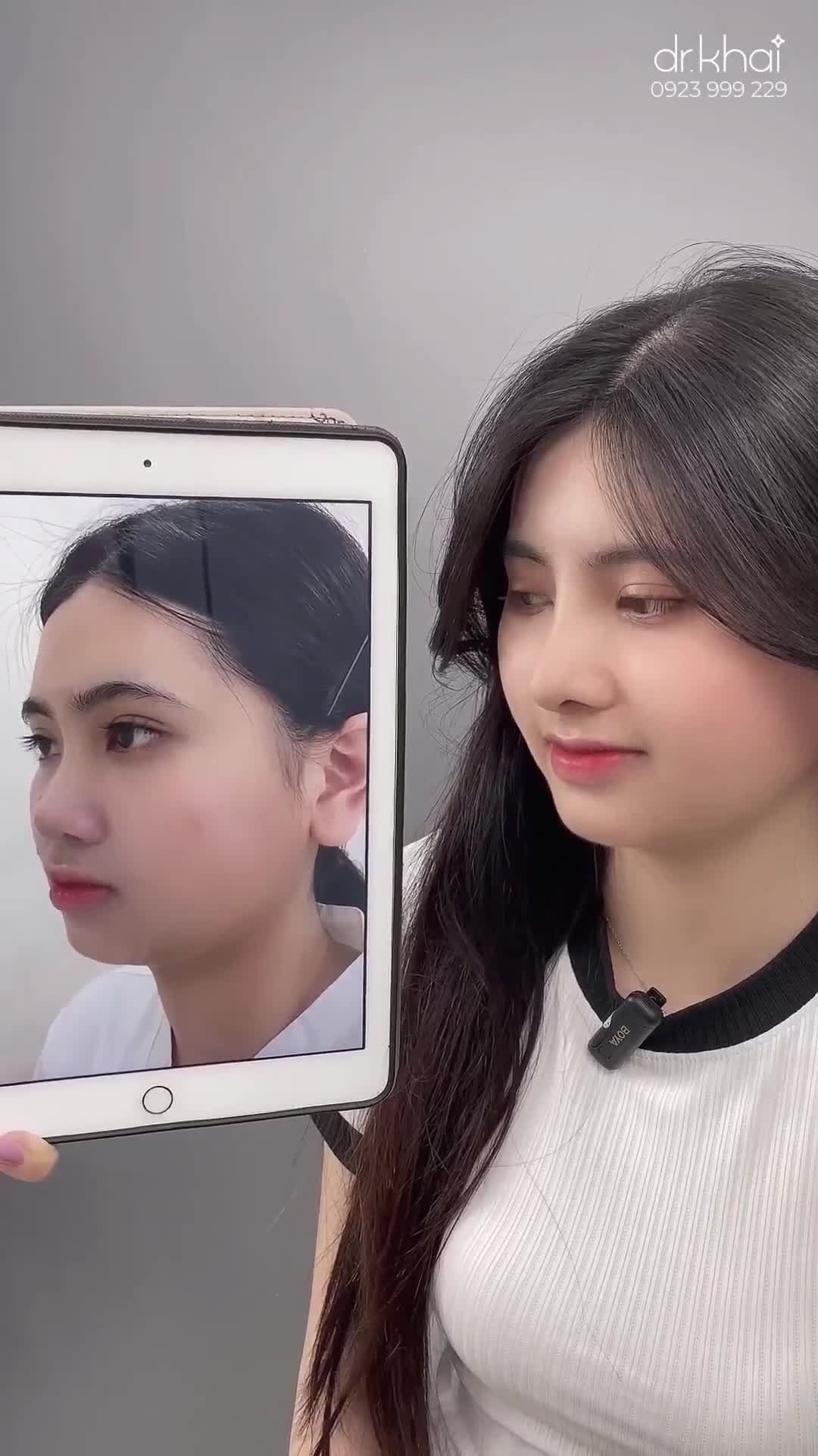 Dáng mũi cấu trúc sau 17 ngày
