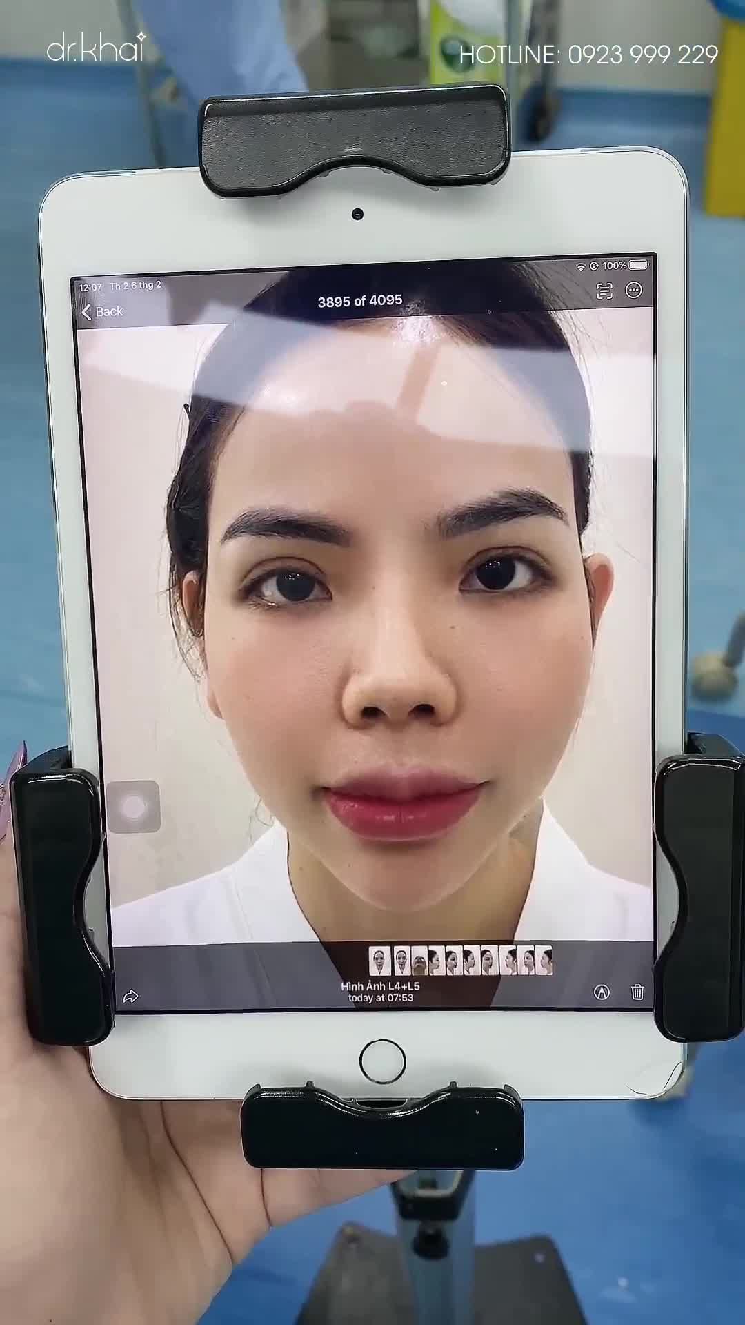CHỈNH SỬA CA MŨI CẤU TRÚC HỎNG BẰNG PHƯƠNG PHÁP TẠO HÌNH ĐẦU MŨI BAY