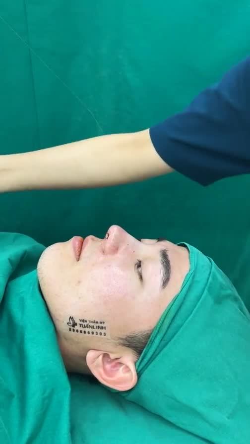 Case mũi cấu trúc vừa hoàn thành