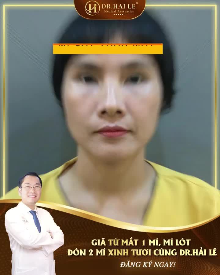 Mắt 1 mí, mí lót, mắt thiếu mỡ đang khiến bạn phải băn khoăn từng ngày?