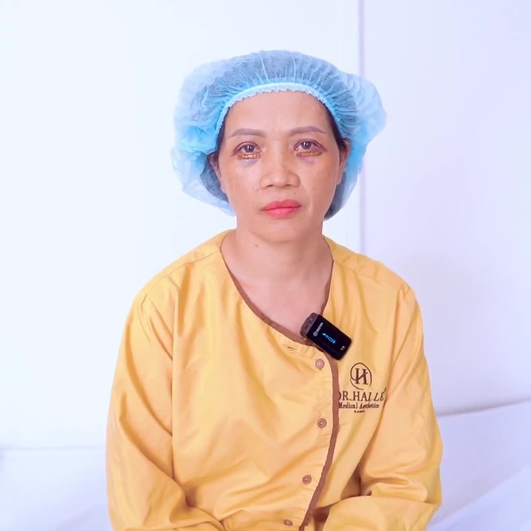 Giải cứu ca mí dưới sa trễ hụt da thành công như thế nào tại Dr.Hải Lê cơ sở HCM