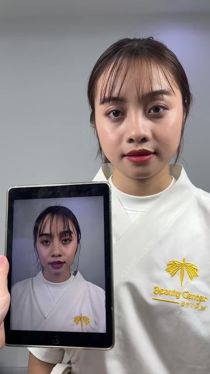 Ca Filler Má, Cằm tại phòng  khám TMV Tấm.