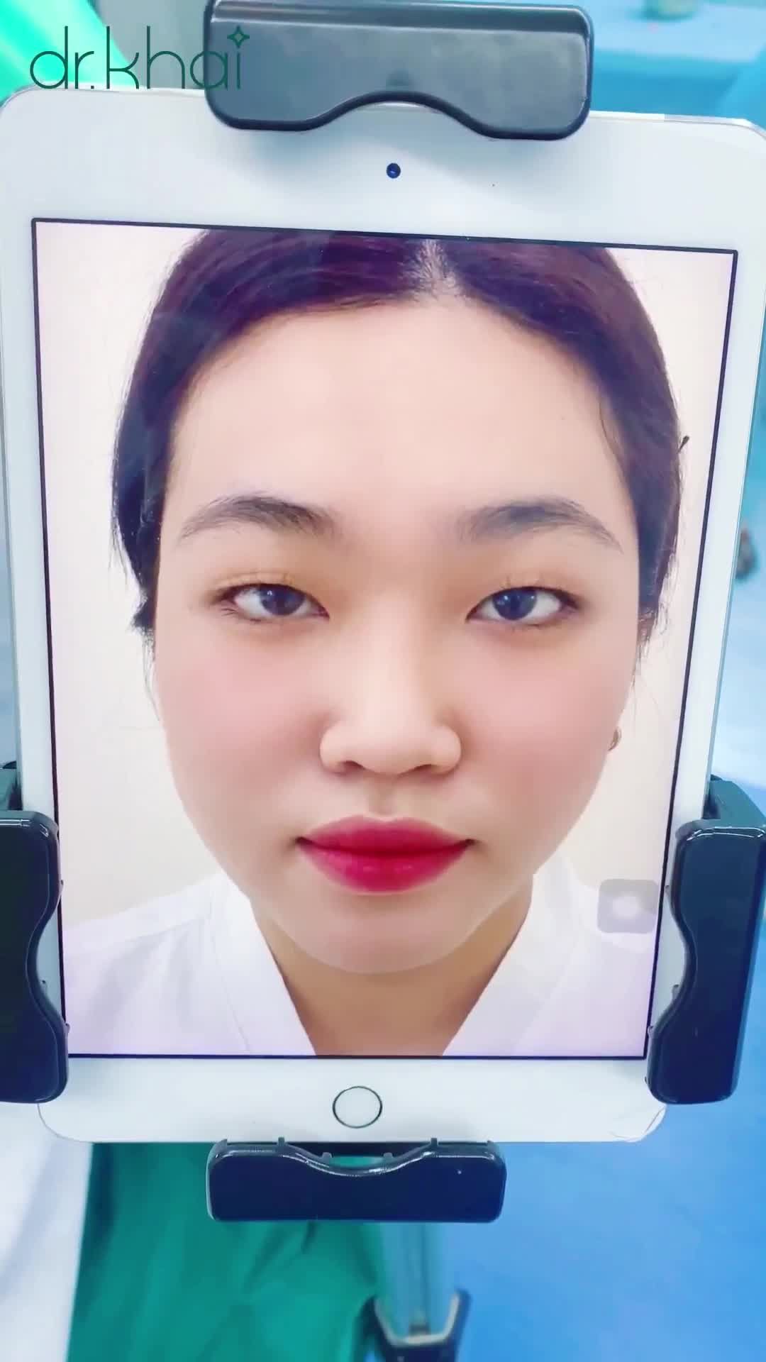 MÍ ĐẸP BẤT NGỜ SAU KHI PHẪU THUẬT ĐẶT LỊCH SỚM NHẬN ƯU ĐÃI GIẢM ĐẾN 40%