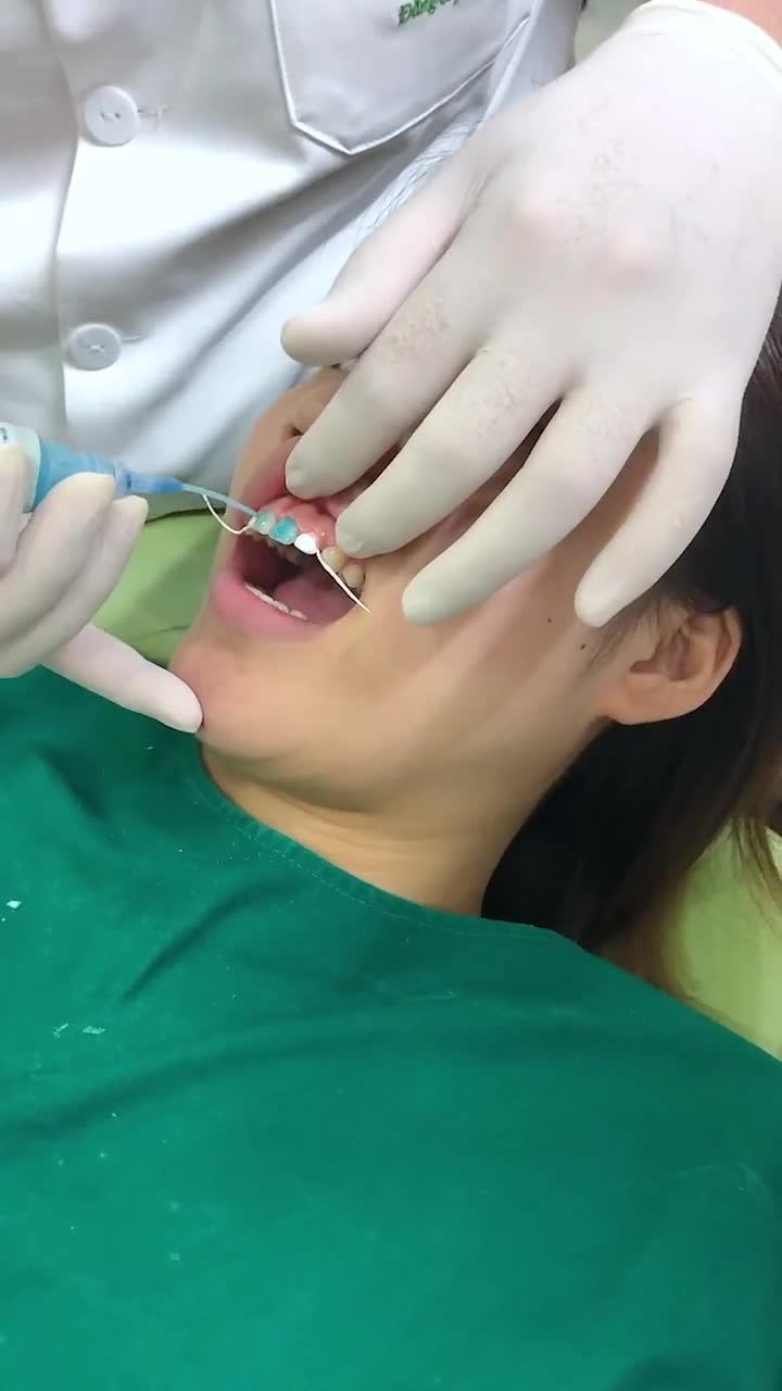 DÁN SỨ VENEER KHÔNG MÀI RĂNG LÀ CÓ THẬT