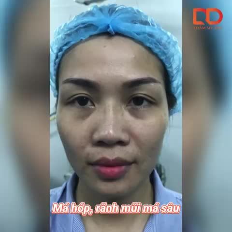 TRẺ RA 10 TUỔI CHỈ NHỜ CẤY MỠ MẶT LÀ CÓ THẬT