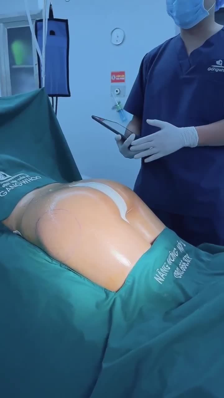 CẤY MỠ MÔNG CẢI THIỆN NHỮNG KHUYẾT ĐIỂM HÕM MÔNG