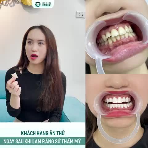 Làm răng sứ thẩm mỹ tại  Sunshine không chỉ đạt yêu cầu về tính thẩm mỹ mà còn đảm bảo chức năng ăn nhai cho khách hàng.
