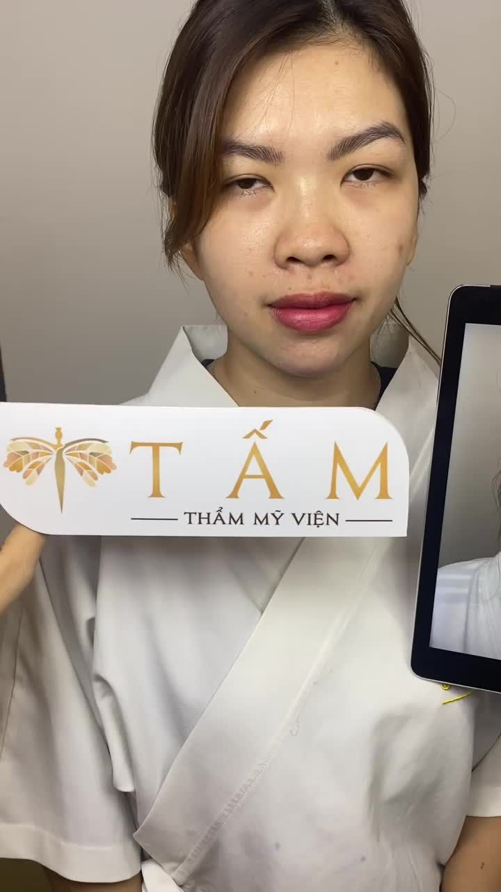 Ca Filler Cằm tại phòng khám TMV Tấm. Sau khi làm dáng cằm của bạn khách đã được cải thiện rõ rệt, giúp gương mặt của bạn hài hoà, cân đối hơn.