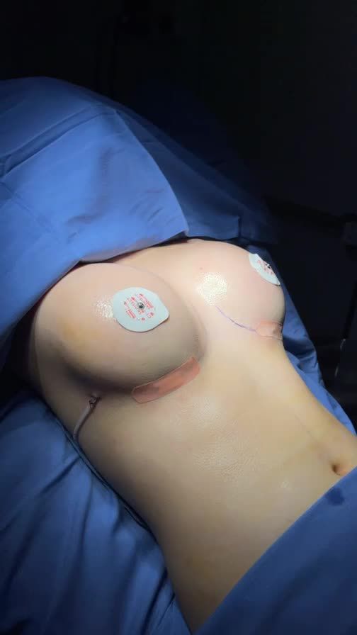 Kết quả phẫu thuật nâng ngực bằng đường chân ngực tại Kangnam