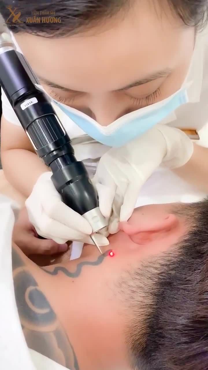 XÓA XĂM AN TOÀN KHÔNG ĐAU CỨ CÔNG NGHỆ LASER HIỆN ĐẠI MÀ CHỌN