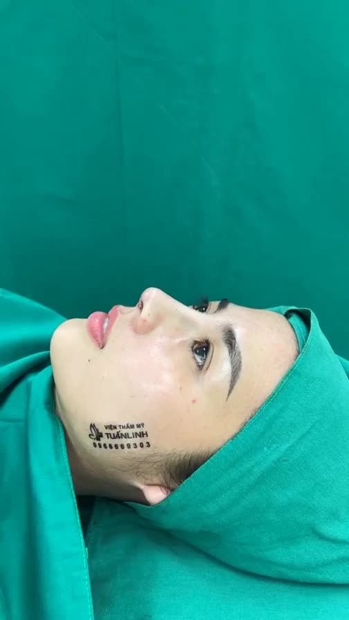 Case mũi cấu trúc bọc megaderm vừa hoàn thành