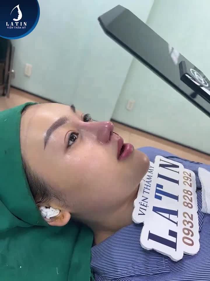 Hoàn thành ca mũi sửa lại cho chị khách đã từng nâng mũi ở nơi khác 8 năm trước nhưng không thành công