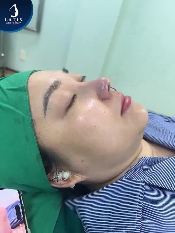 Mũi đã nâng nhưng bị lộ sóng, đầu mũi ngắn, hếch và bị bao xơ, hai bên cánh mũi không đồng đều, sửa lại như thế nào?