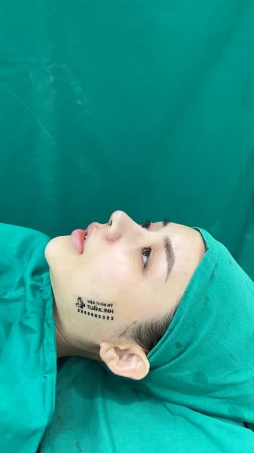 Case mũi cấu trúc sửa lại bọc megaderm toàn sóng